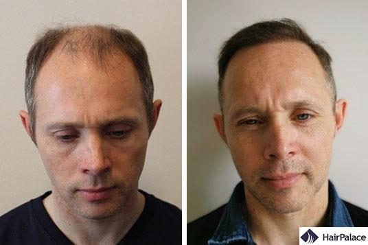 hair transplant uk